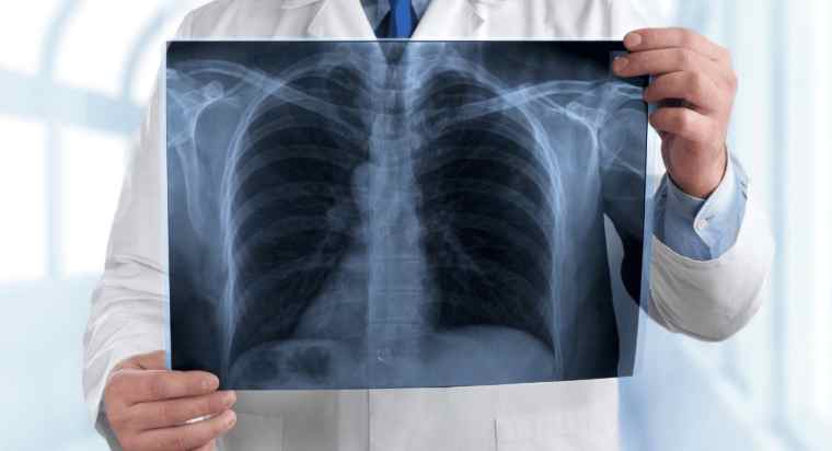 Walking Pneumonia: What it is and how to manage it